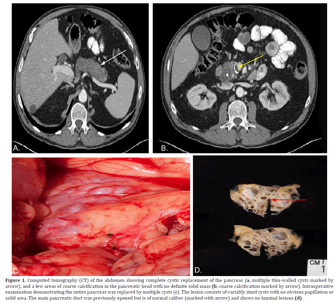 pancreas-computed-tomography