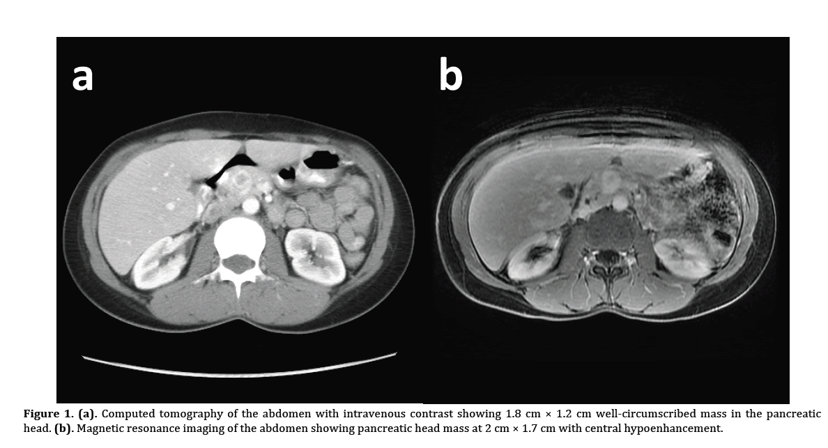 pancreas-computed-tomography