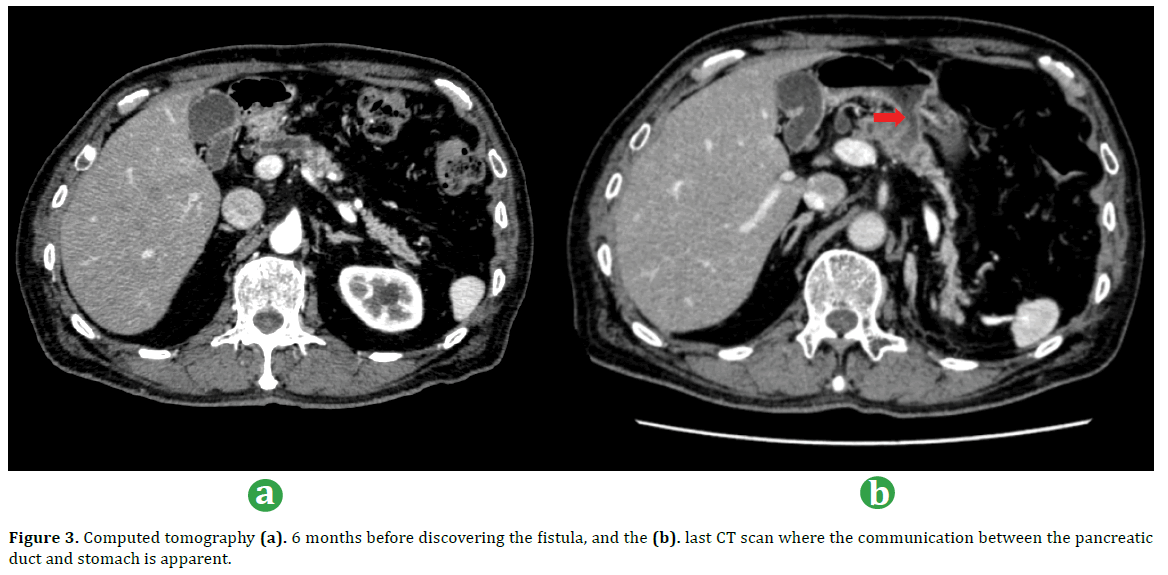 pancreas-computed-tomography