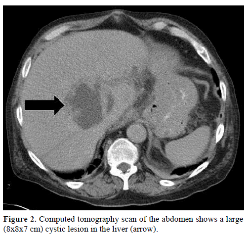 pancreas-computed-tomography-abdomen-cystic