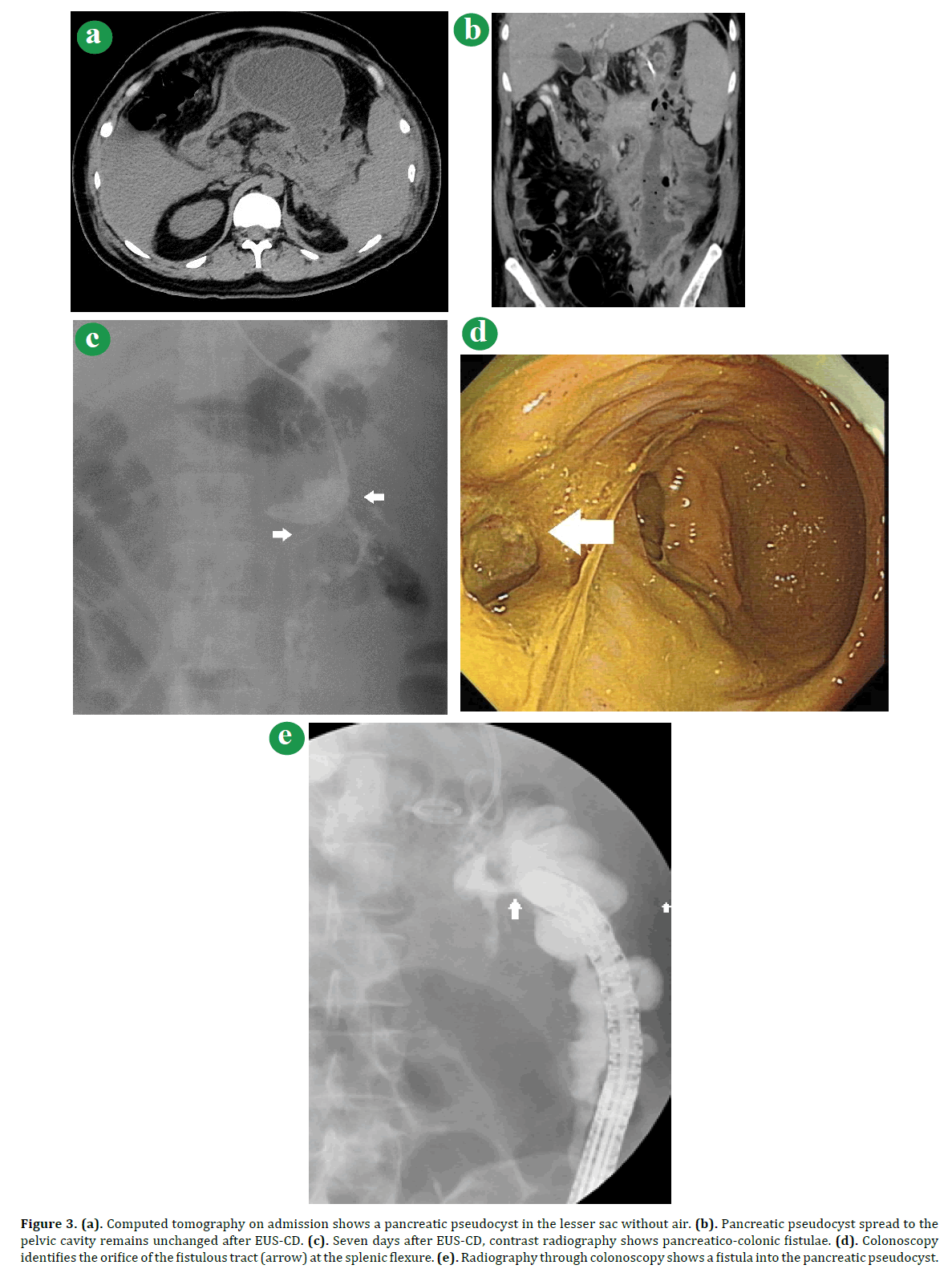 pancreas-computed-tomography-admission