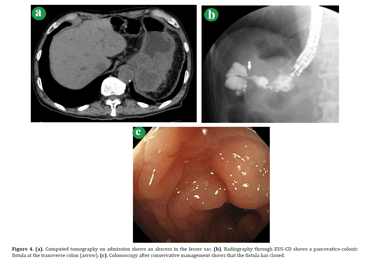 pancreas-computed-tomography-admission