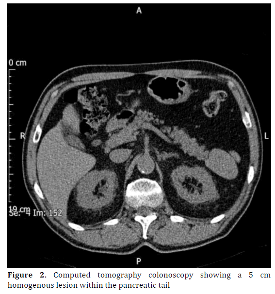 pancreas-computed-tomography-colonoscopy