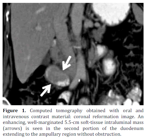pancreas-computed-tomography-coronal