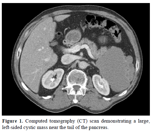 pancreas-computed-tomography-cystic