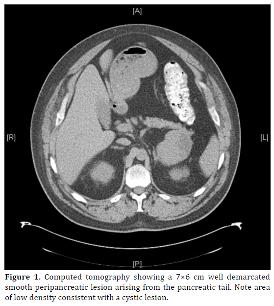 pancreas-computed-tomography-demarcated