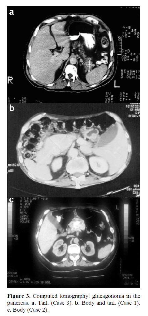 pancreas-computed-tomography-glucagonoma