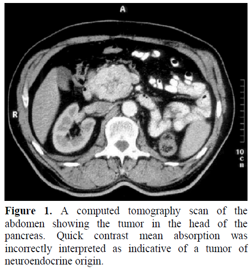 pancreas-computed-tomography-indicative