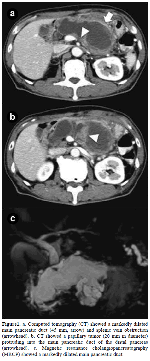 pancreas-computed-tomography-markedly