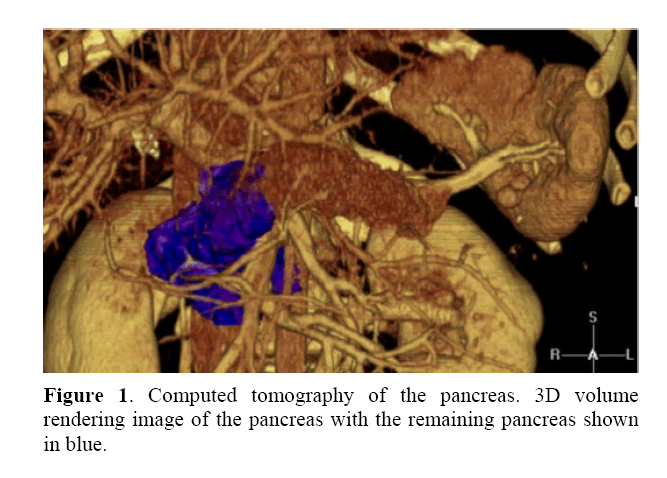 pancreas-computed-tomography-pancreas