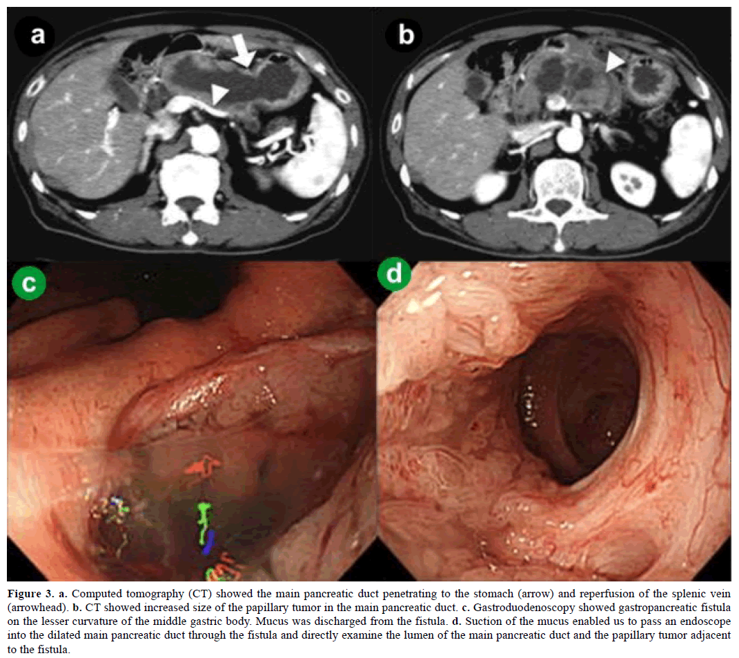 pancreas-computed-tomography-pancreatic