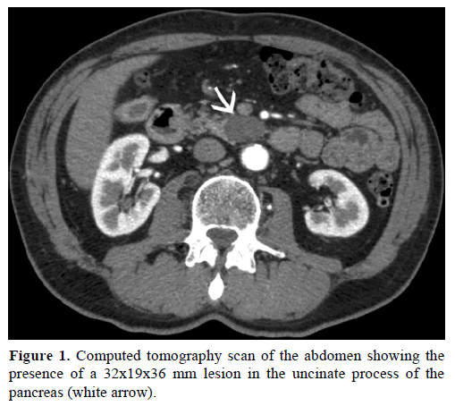 pancreas-computed-tomography-scan