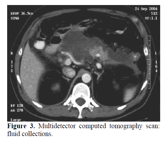 pancreas-computed-tomography-scan