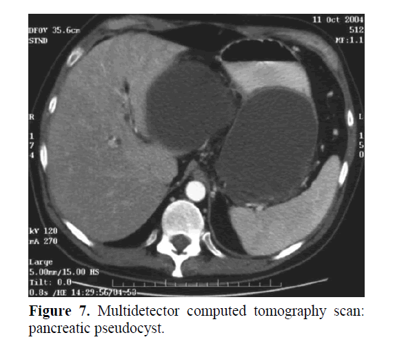 pancreas-computed-tomography-scan