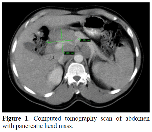 pancreas-computed-tomography-scan