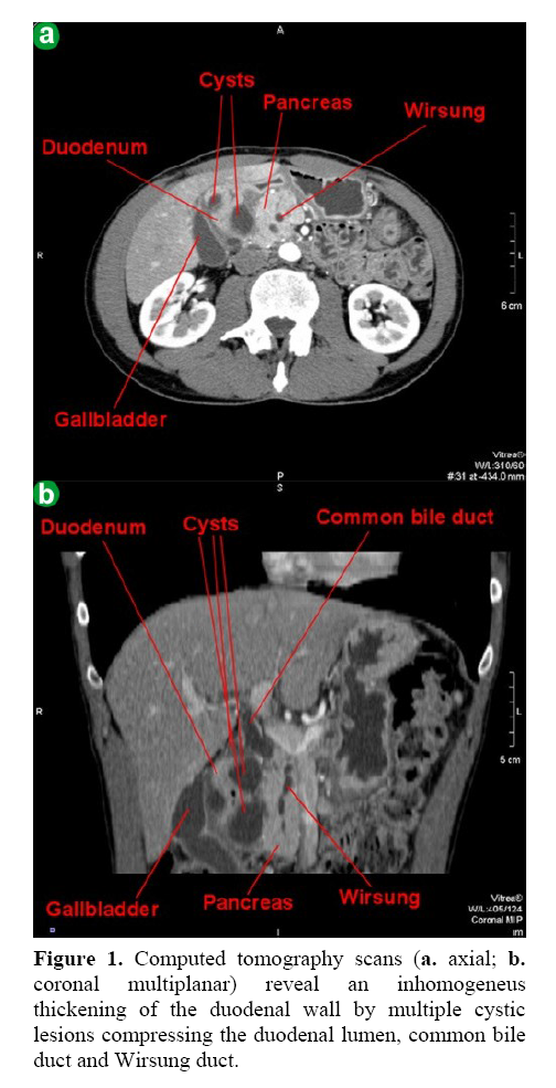 pancreas-computed-tomography-scans