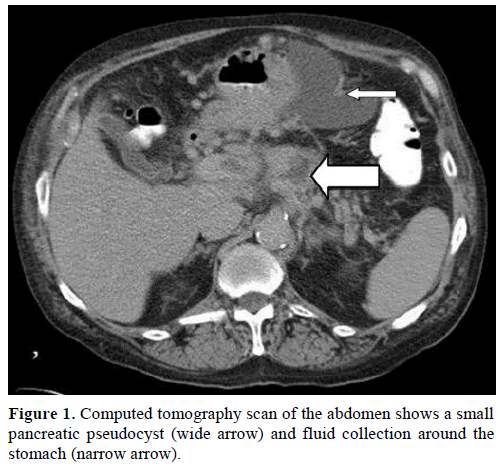 pancreas-computed-tomography-small-pancreatic
