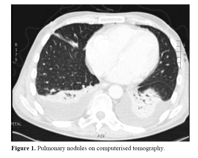 pancreas-computerised-tomography