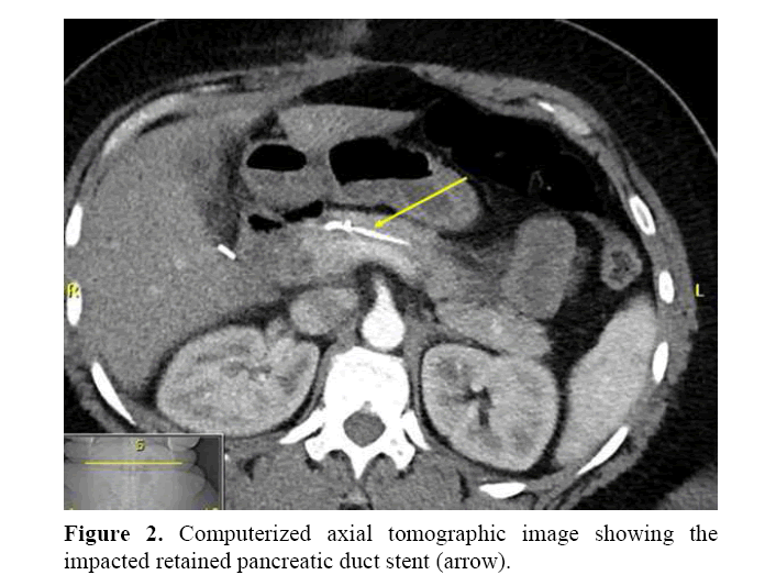 pancreas-computerized-axial-tomographic