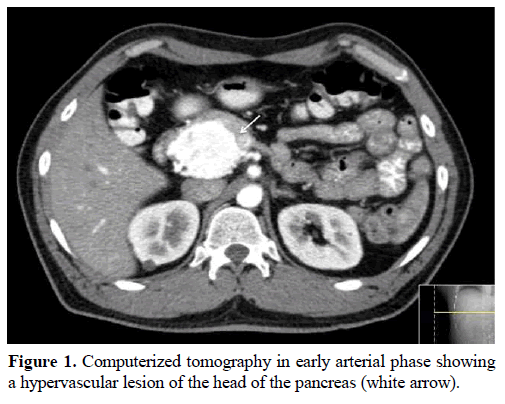 pancreas-computerized-tomography