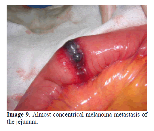 pancreas-concentrical-melanoma-metastasis