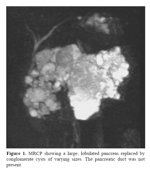 pancreas-conglomerate-cysts-varying