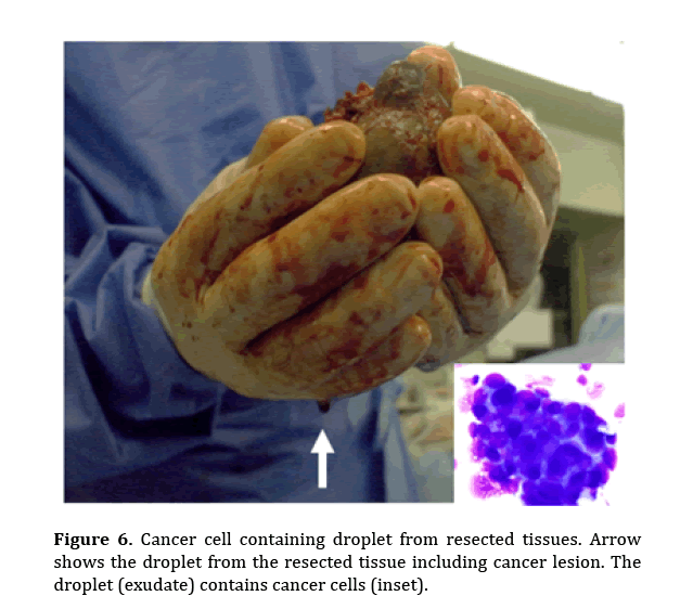 pancreas-contains-cancer-cells