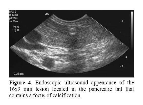 pancreas-contains-focus-calcification