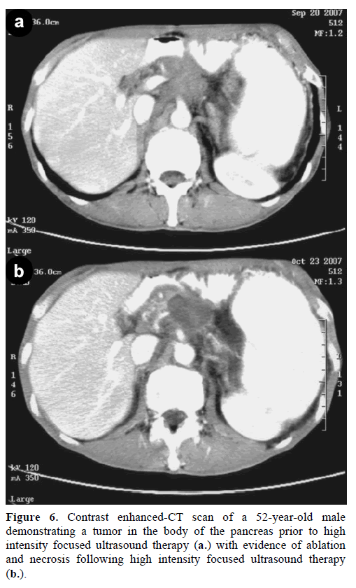 pancreas-contrast-enhanced-52-year-old