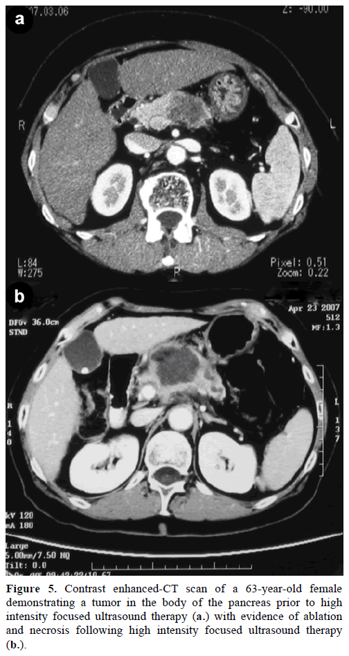 pancreas-contrast-enhanced-63-year-old