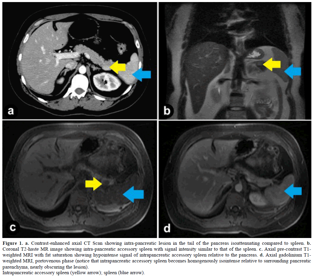 pancreas-contrast-enhanced-axial-ct-scan