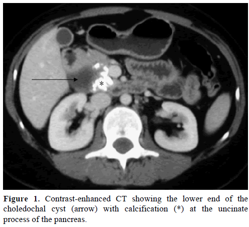 pancreas-contrast-enhanced-choledochal-cyst