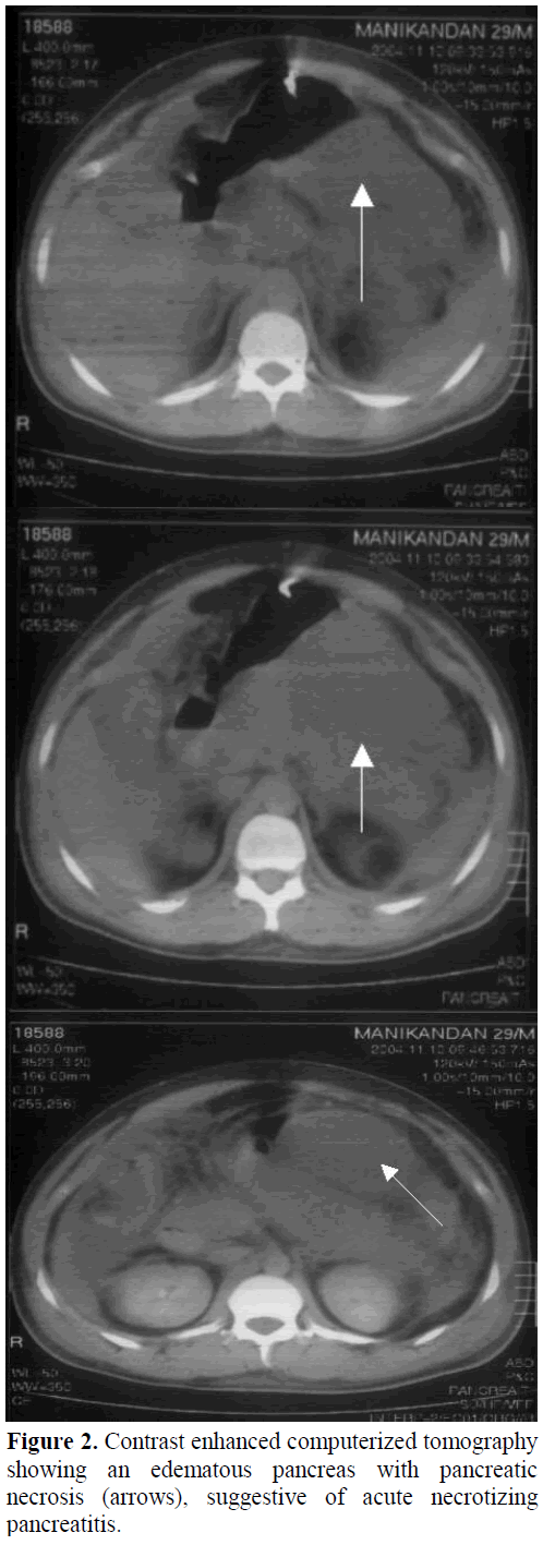 pancreas-contrast-enhanced-computerized