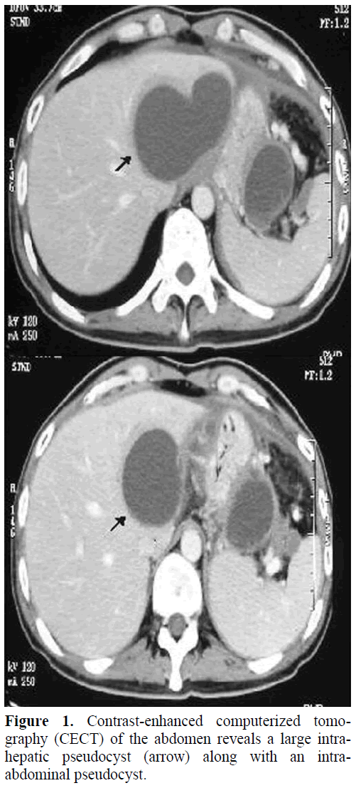 pancreas-contrast-enhanced-computerized