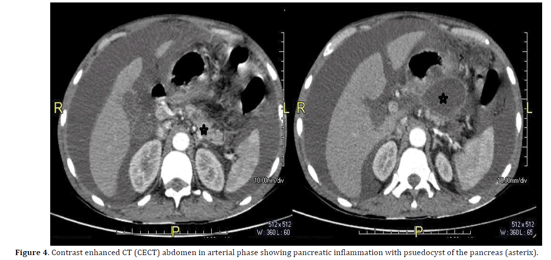 pancreas-contrast-enhanced-ct-abdomen