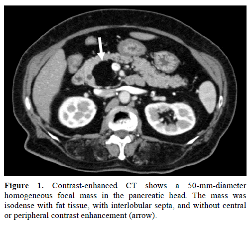 pancreas-contrast-enhanced-focal-mass