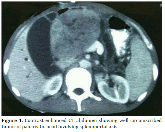 pancreas-contrast-enhanced-splenoportal