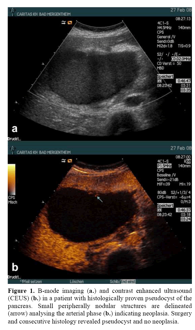 pancreas-contrast-enhanced-ultrasound