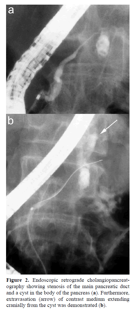 pancreas-contrast-medium-extending