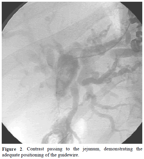 pancreas-contrast-passing-jejunum