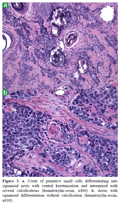 pancreas-cords-primitive-small-cells