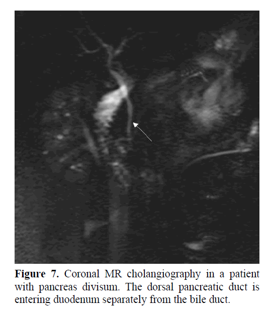 pancreas-coronal-MR-cholangiography