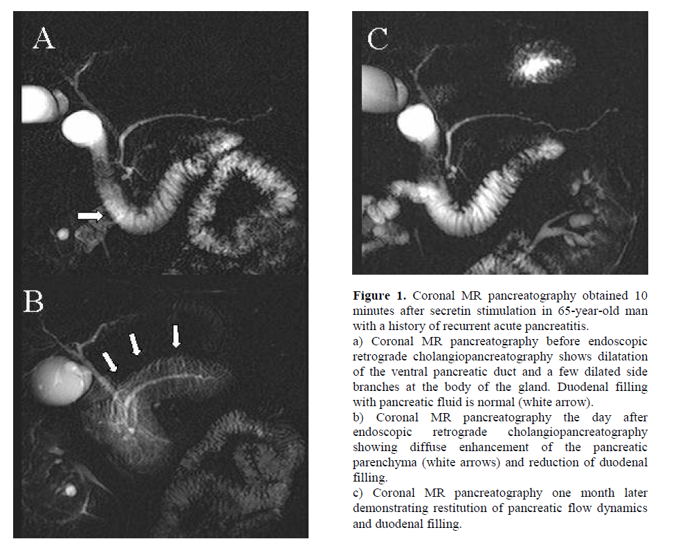 pancreas-coronal-MR-pancreatography