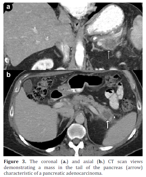 pancreas-coronal-axial-pancreatic