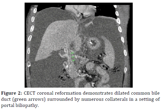 pancreas-coronal-collaterals-biliopathy