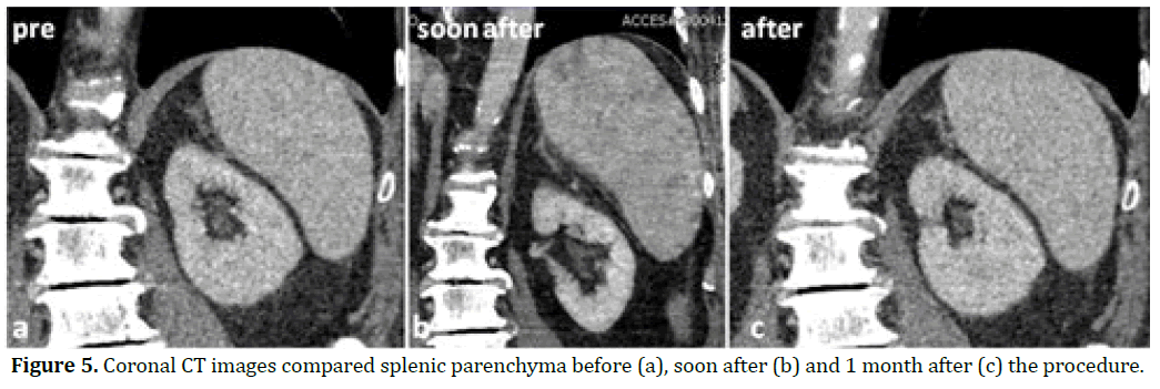 pancreas-coronal-ct-images-parenchyma