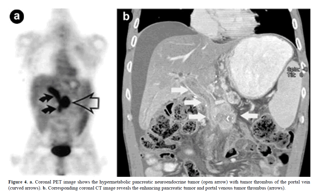 pancreas-coronal-hypermetabolic-pancreatic