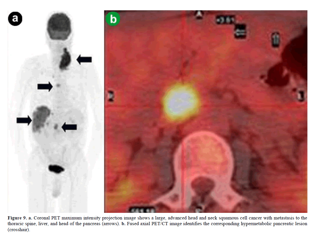 pancreas-coronal-maximum-advanced-head