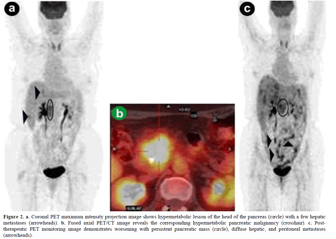 pancreas-coronal-maximum-projection