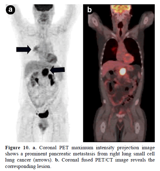 pancreas-coronal-maximum-prominent